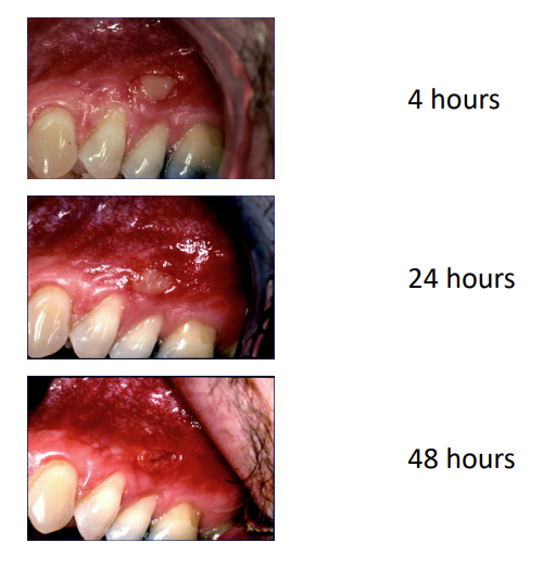 <ul><li><p>final result due to maturation may take months to fully complete </p></li><li><p>image - punch biopsy </p></li></ul><p></p>
