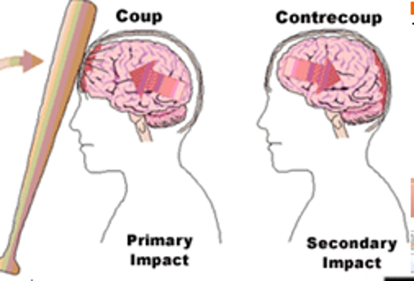 <p>Rapid acceleration/deceleration</p><p>-The brain is damaged on the opposite side</p><p>- car accidents</p>