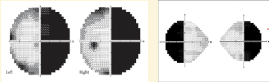<ul><li><p>Affects one half of Visual Field → 2 quadrants </p></li></ul><p></p><ul><li><p>respects vertical midline </p></li></ul><p></p><ul><li><p>Highly congrues</p></li></ul><p></p><p>affects back of head → stroke, tumour</p><ul><li><p>e.g pituitary tumour </p></li></ul><p></p>