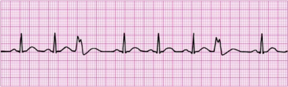 <p>what rhythm is shown in the ECG?</p>