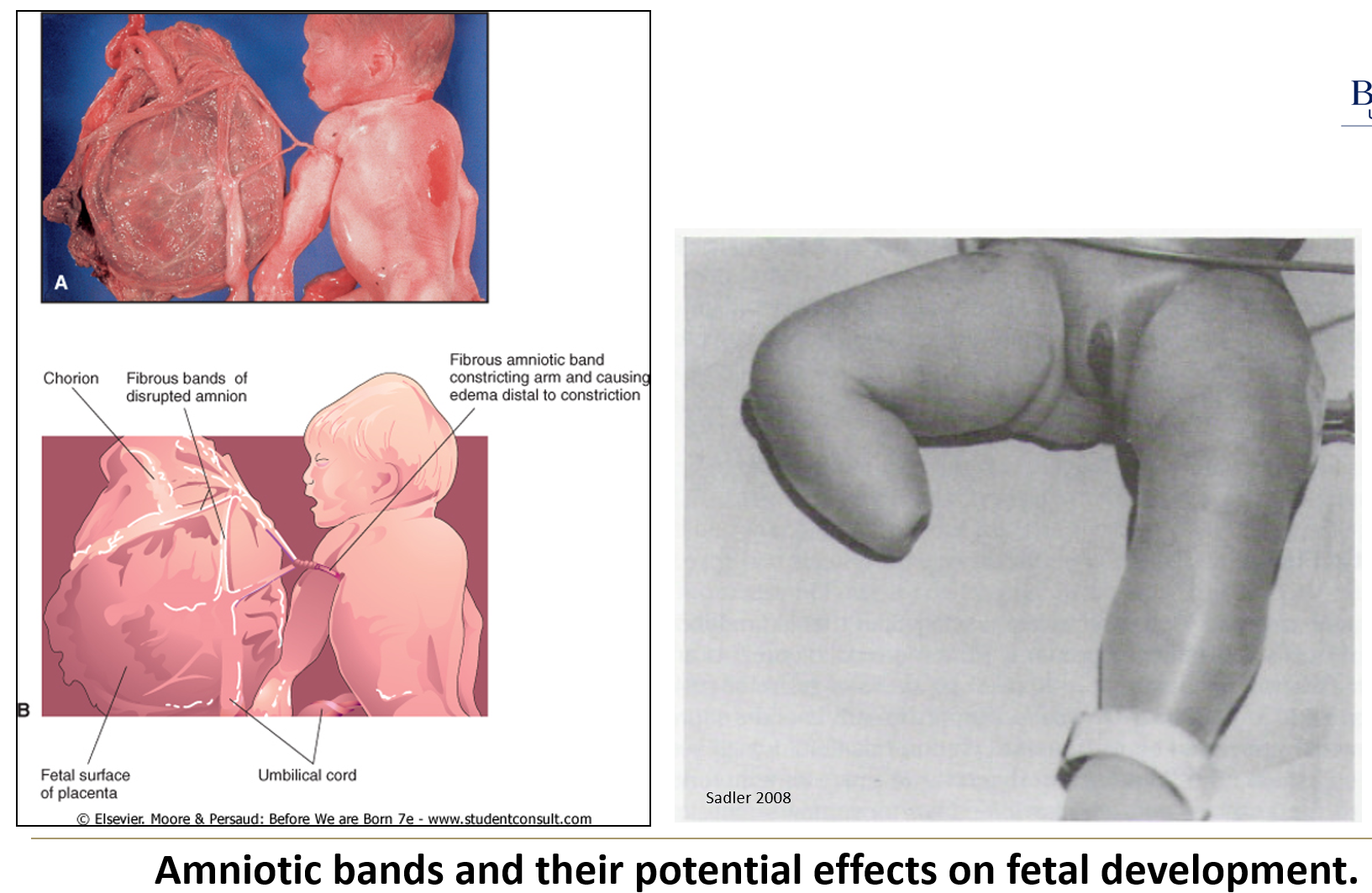 <ul><li><p>They result from <strong>tears in the amnion</strong>, often due to <strong>infection or toxic insult</strong>.</p></li><li><p>These bands may <strong>encircle fetal extremities or head</strong>, leading to <strong>amputations</strong>, <strong>ring constrictions</strong>, or <strong>craniofacial abnormalities</strong>.</p></li></ul><p></p>