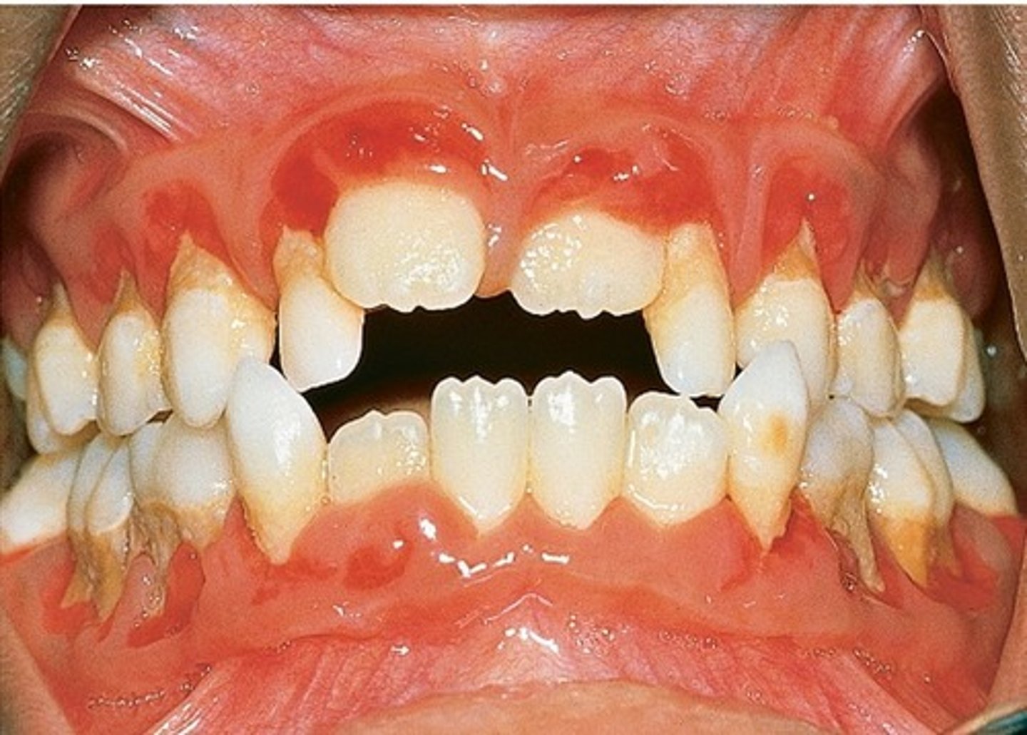 <p>PAINFUL </p><p>• genetic</p><p>• multiple deep ulcers for 21 days </p>