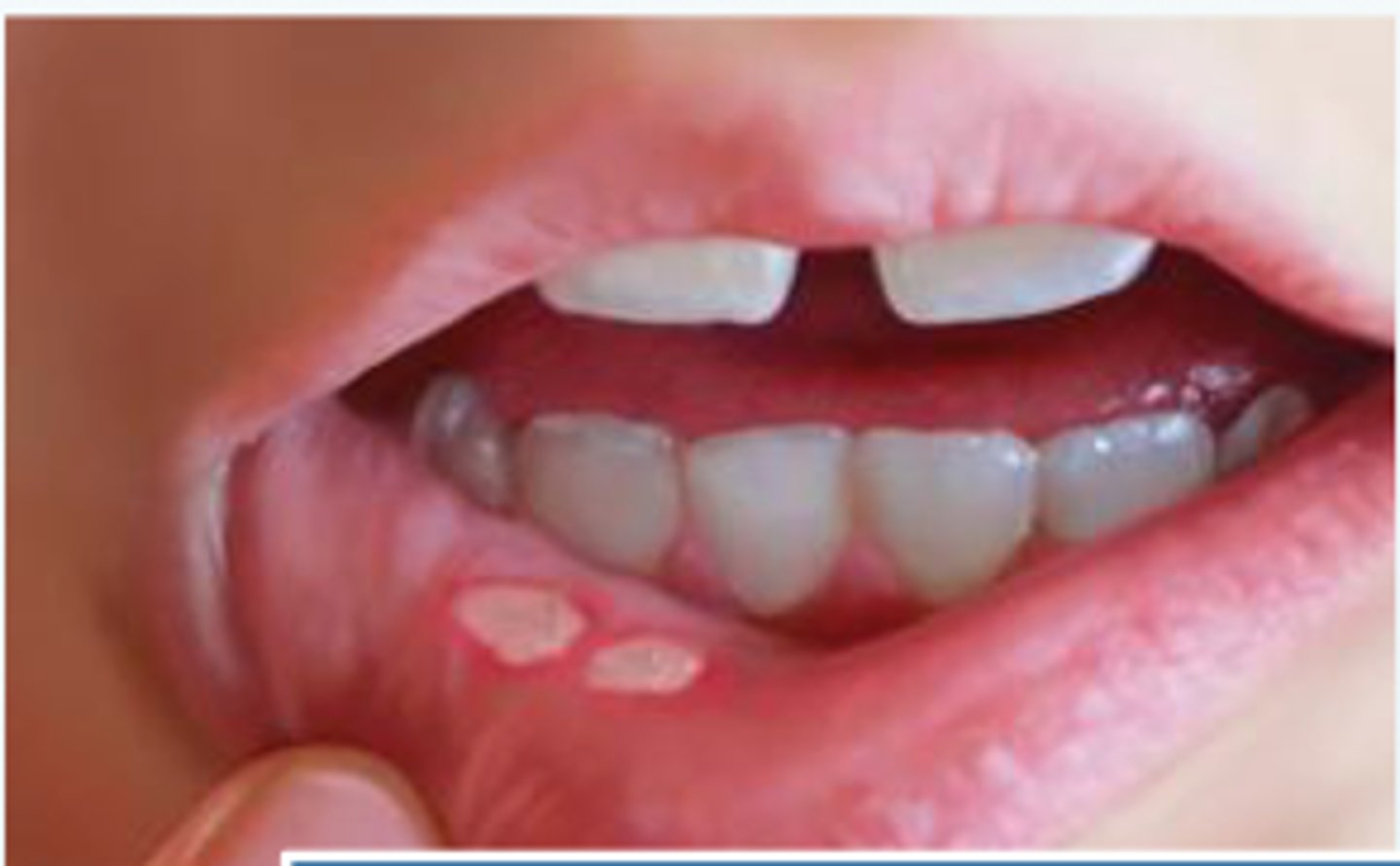 <p>heal without scarring </p><p>1-5 lessions</p><p>7-14 days </p><p>few</p><p>short</p><p>non-keratinized </p><p>self limited</p><p>KANKER SORES</p>