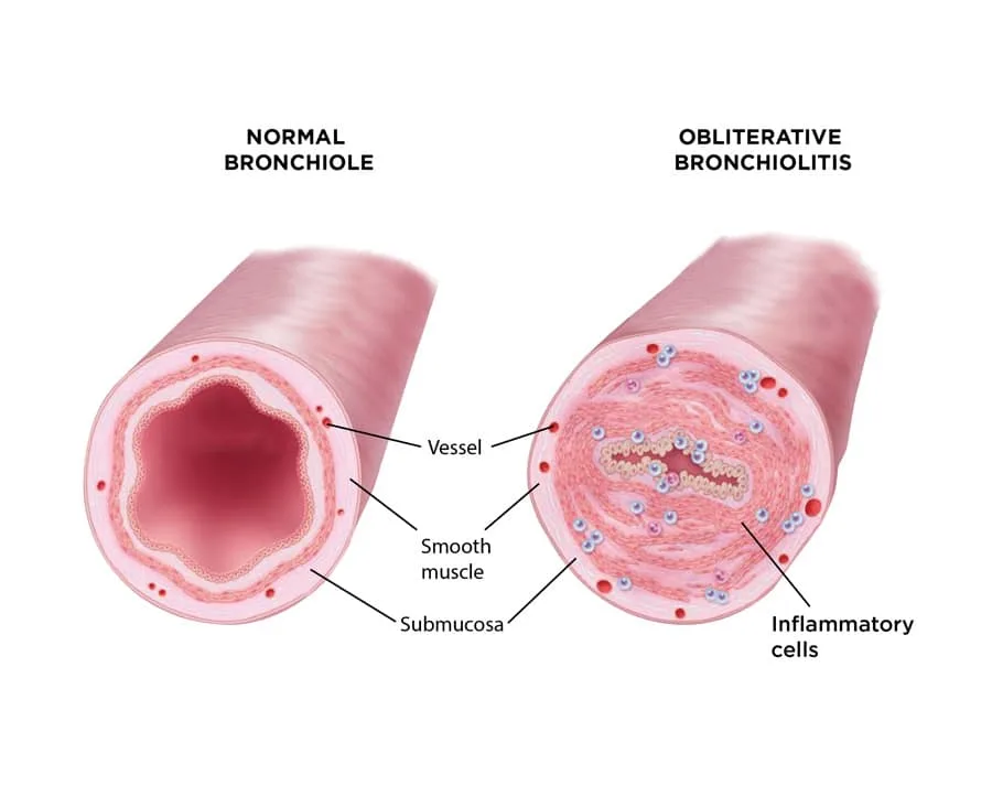 <p>bronchiolitis obliterans </p>
