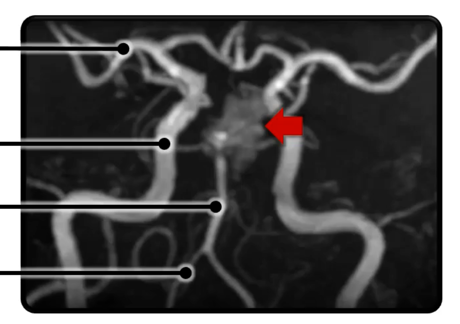 <ul><li><p>Middle Cerebral Artery</p></li><li><p>Internal Carotid Artery</p></li><li><p>Basilar Artery</p></li><li><p>Vertebral Artery</p></li></ul><p></p>