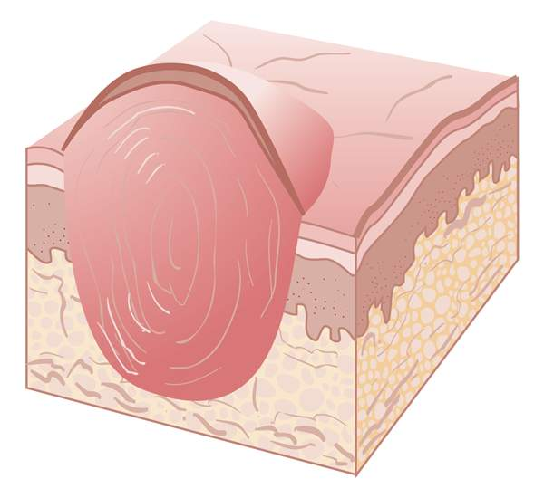<p>firm and movable solid&nbsp;<span>elevation 0.5–1 cm in diameter and extends deeper into the dermis than a papule</span></p>