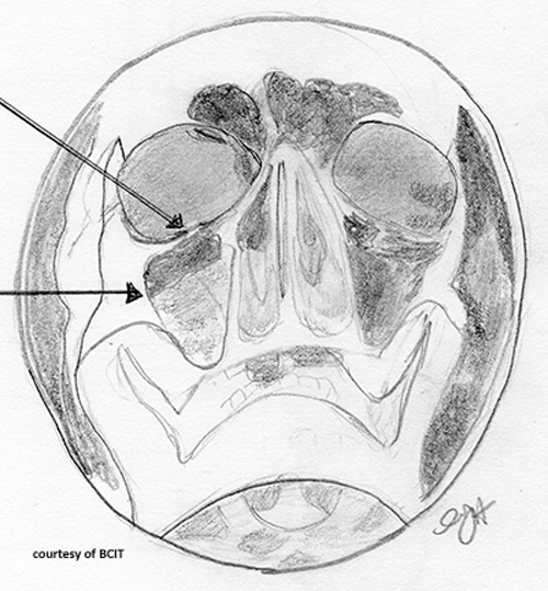 <p>What is a possible complication of maxilla fracture affecting vision?</p>