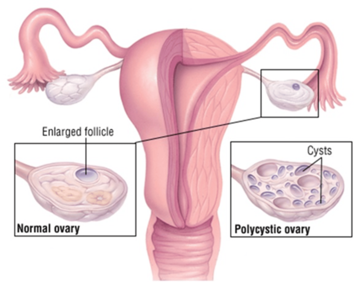 <p>-endocrine disorder associated with chronic anovulation</p><p>-affects women 20 - 40 years old</p><p>-affected follicles neither secrete progesterone that suppresses menstruation nor release an ovum</p>