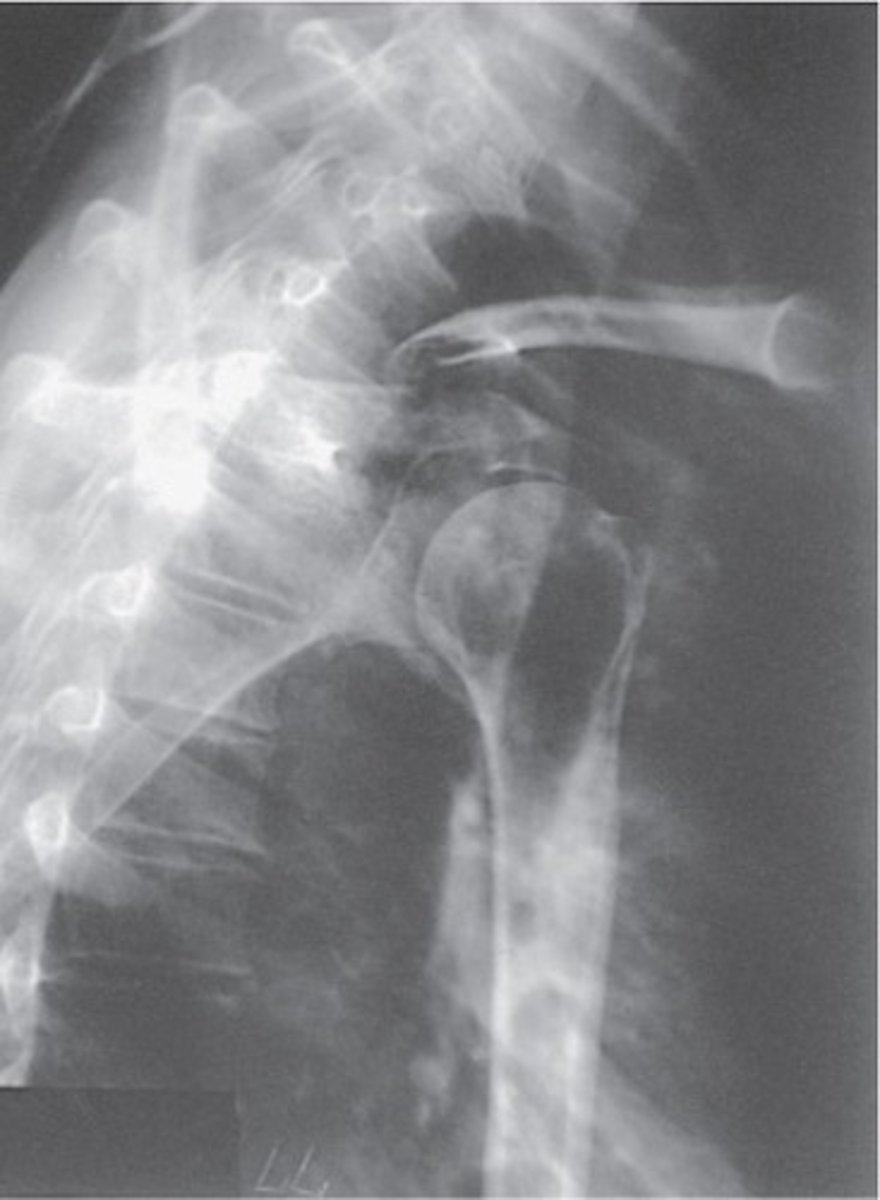 <p>- scapula, clavicle, and humerus</p><p>- thoracic spine</p><p>- the shoudler closest to the IR</p>
