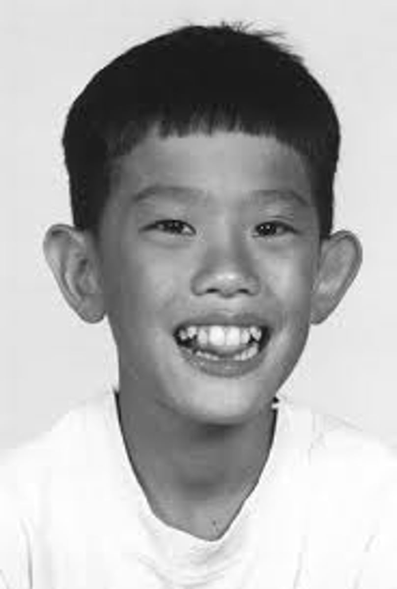 <p>Most common type of MR in boys, Macrocephaly, macro- orchidism, large ears.</p>