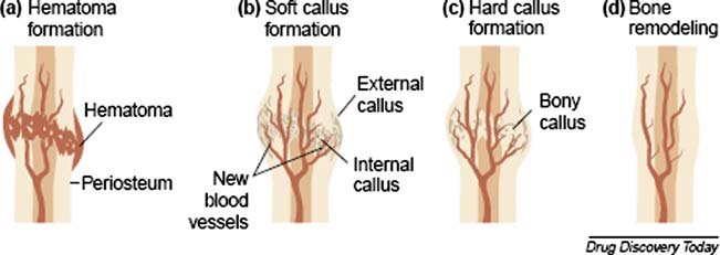 <p>hematoma forms from fracture → blood clot</p><p>-BV torn within periosteum</p>