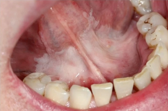 <p>what is the concern with this lesion </p>