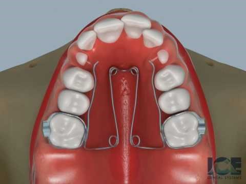 <p>Fixed expansion</p><p>Widens upper arch</p>