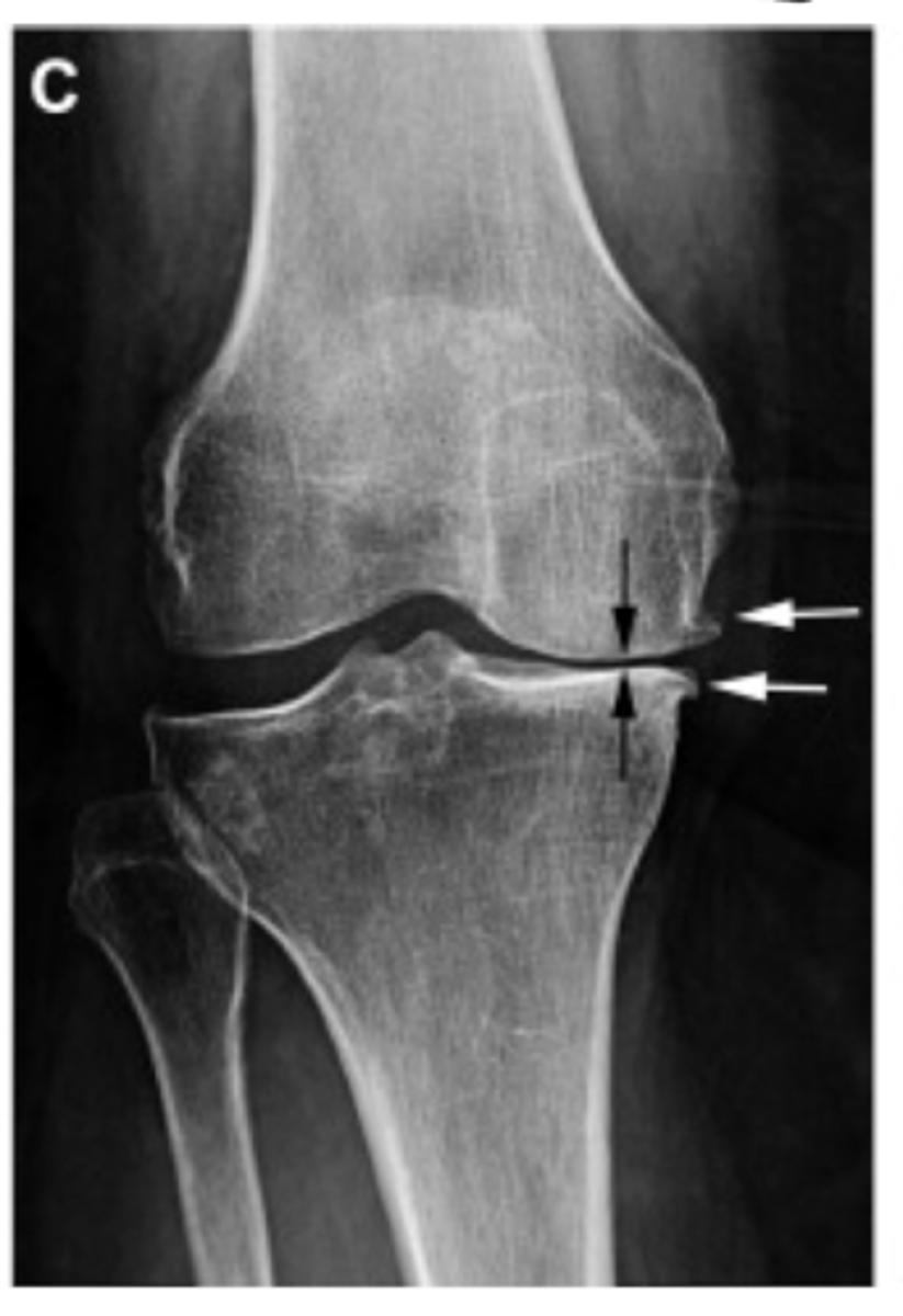 <p>Define the Kelgren Lawrence grade. How do you know?</p>