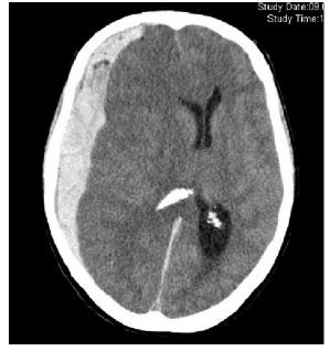 <p>accumulation of blood (bridging veins) between dura and arachnoid mater that is from acute or chronic occurrences with a crescent-shape on CT</p>