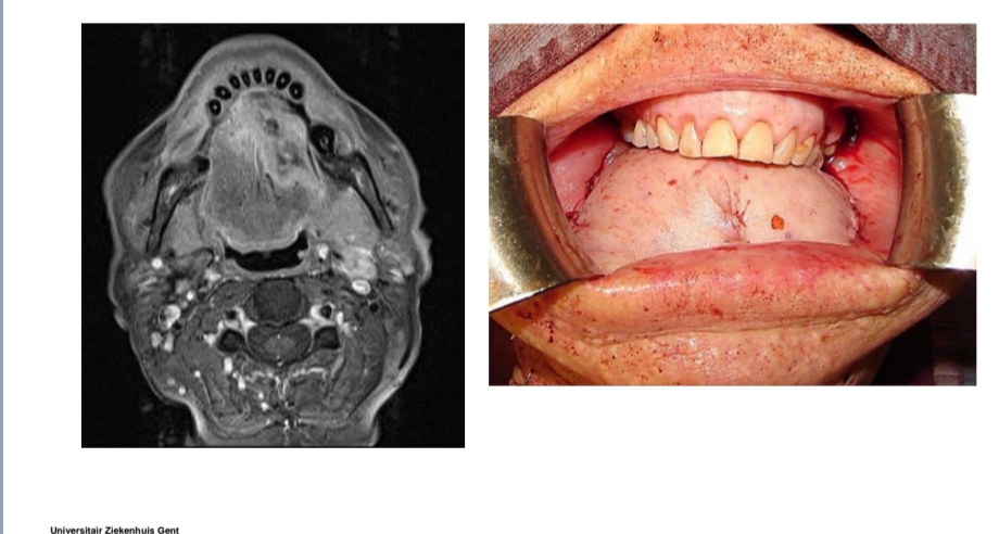 <p>geen spraak en slik functie</p><p>→ w niet vaak gedaan → want geen levenskwaliteit</p>