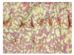 <p>variable (depends on the patient)</p><p>asymptomatic to potentially fatal</p><ul><li><p>diarrhea, stomach cramps, nausea, fever, loss of appetite, acute abdomen colitis</p></li></ul><p>plaques of yellow fibrin and inflammatory debris adherent to reddened mucosa</p>