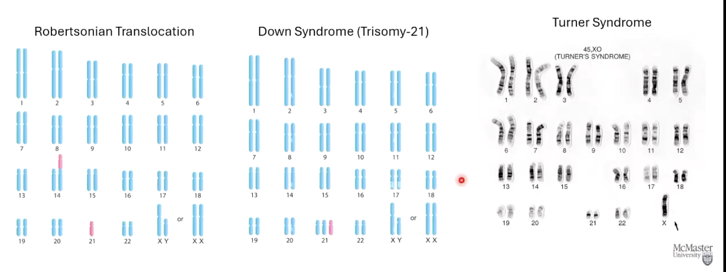 <ul><li><p>Robertsonian Translocation </p><ul><li><p>Chromosome 21 translocates to chromosome 14</p></li></ul></li><li><p>Down syndrome (Trisonomy-21)</p><ul><li><p>3 chromosome 21s</p></li></ul></li><li><p>Turner Syndrome</p><ul><li><p>Female missing X chromosome</p></li><li><p>No Y chromosome</p></li></ul></li></ul><p></p>