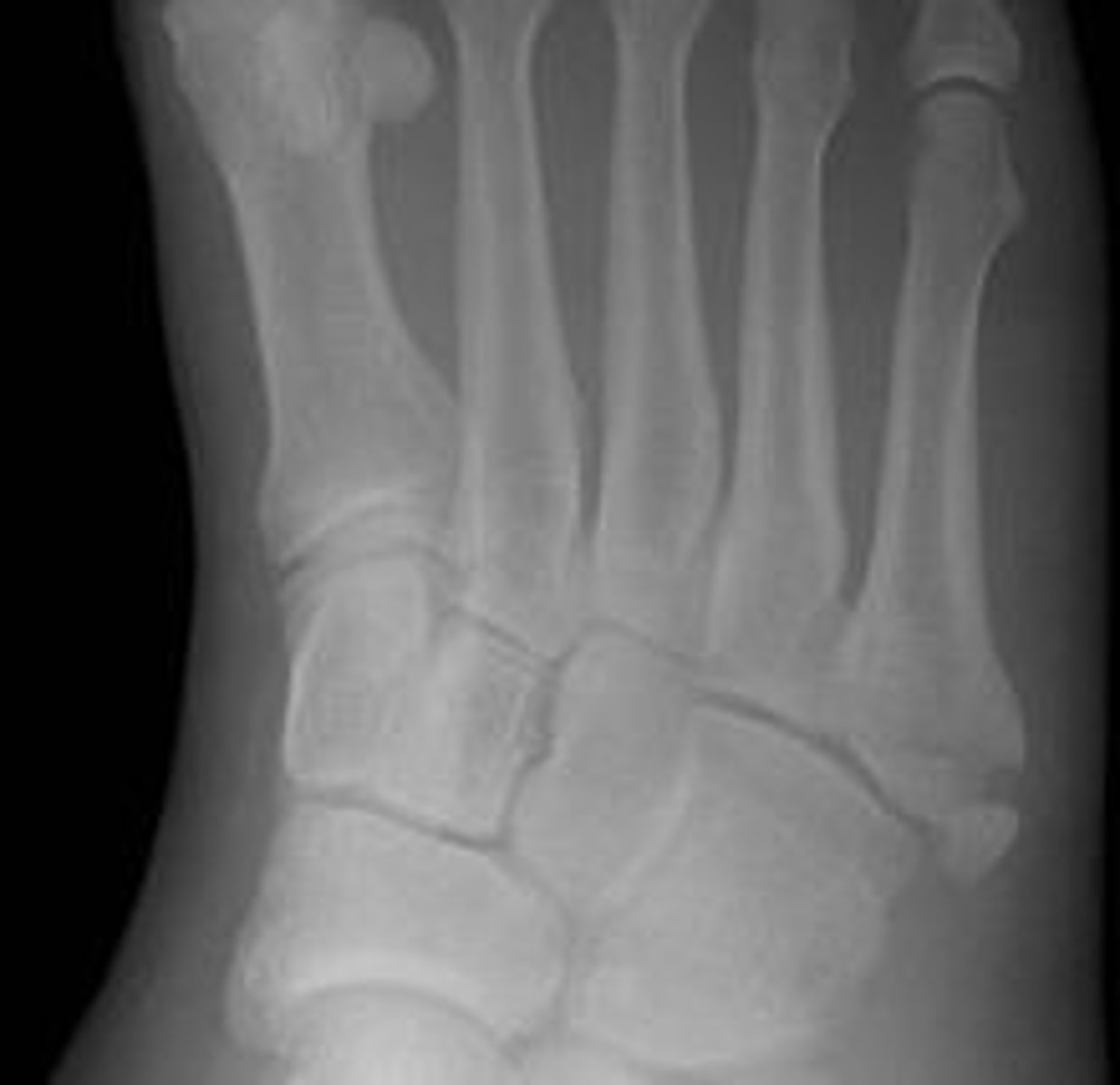 <p>- also known as pseudo-Jones fracture , forceful contractions from the fibularis brevis causes break in base of 5th metatarsal</p><p>- presents with avoidance of push off phase and point tenderness at the base of the 5th metatarsal</p>