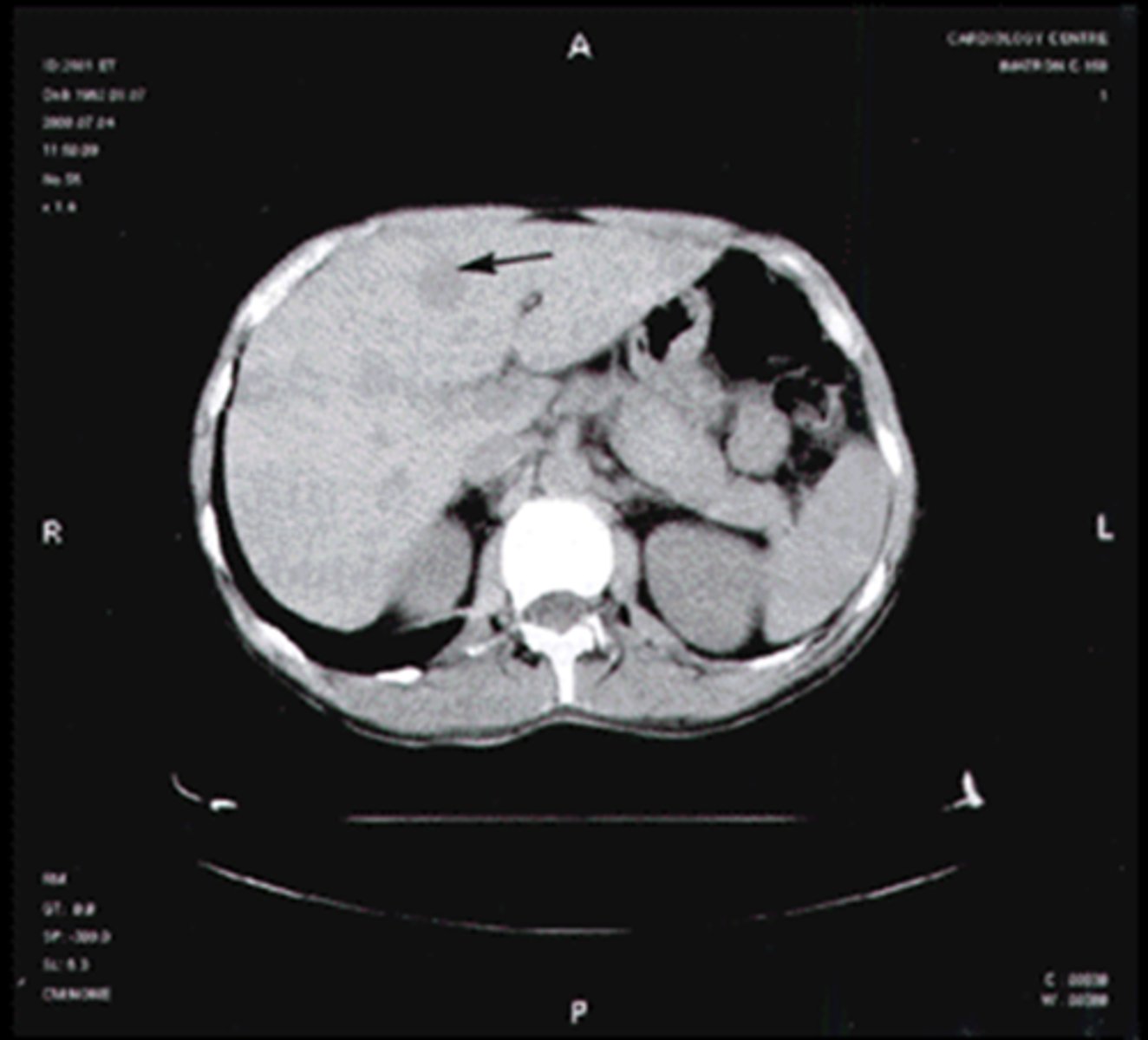 <p>most common benign hepatic tumor, often found incidentally on US and CT, looks like normal liver with contrast</p>