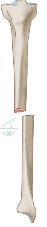 <p>what type of fracture is this?</p>
