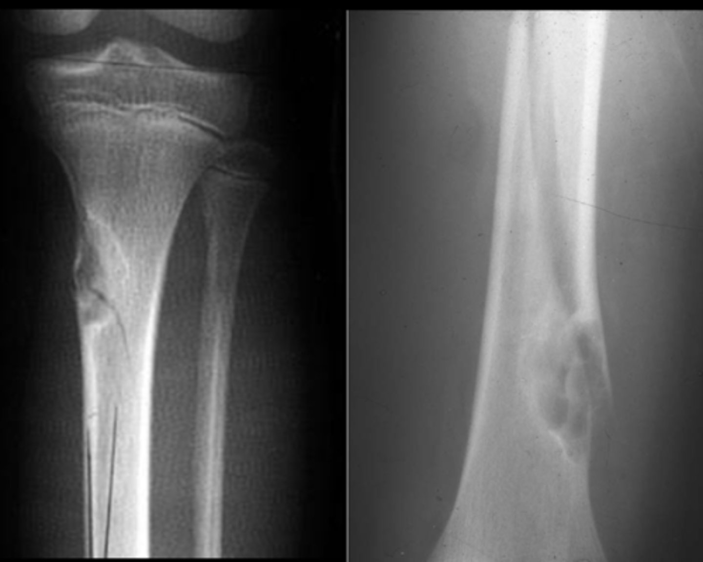 <p>Non-ossifying fibroma with _____</p>