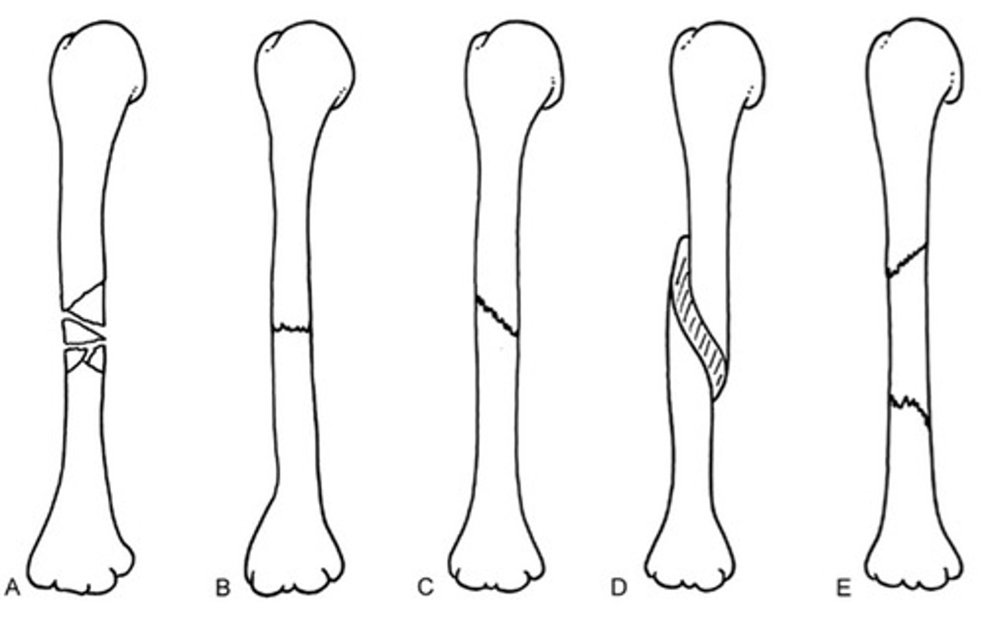 <p>A: comminuted</p><p>B: transverse</p><p>C: oblique</p><p>D: spiral</p><p>E: segmental</p>