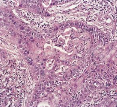 <p>Carcinoma de células escamosas, nivel de diferenciación</p>