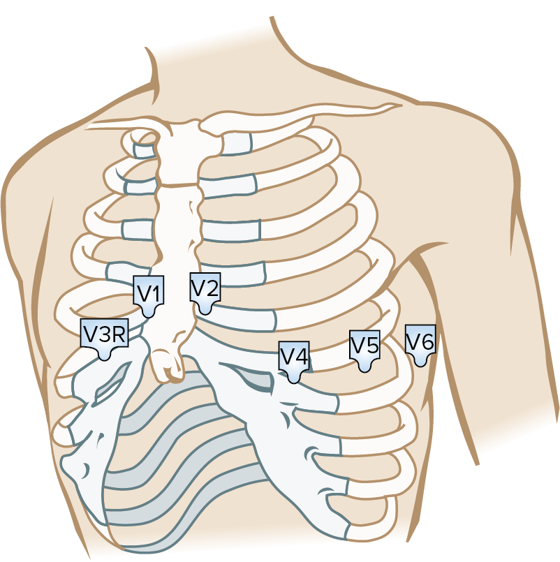 <p>Move V3 and V4 to the right side of the chest. This is known as V3R and V4R. </p>
