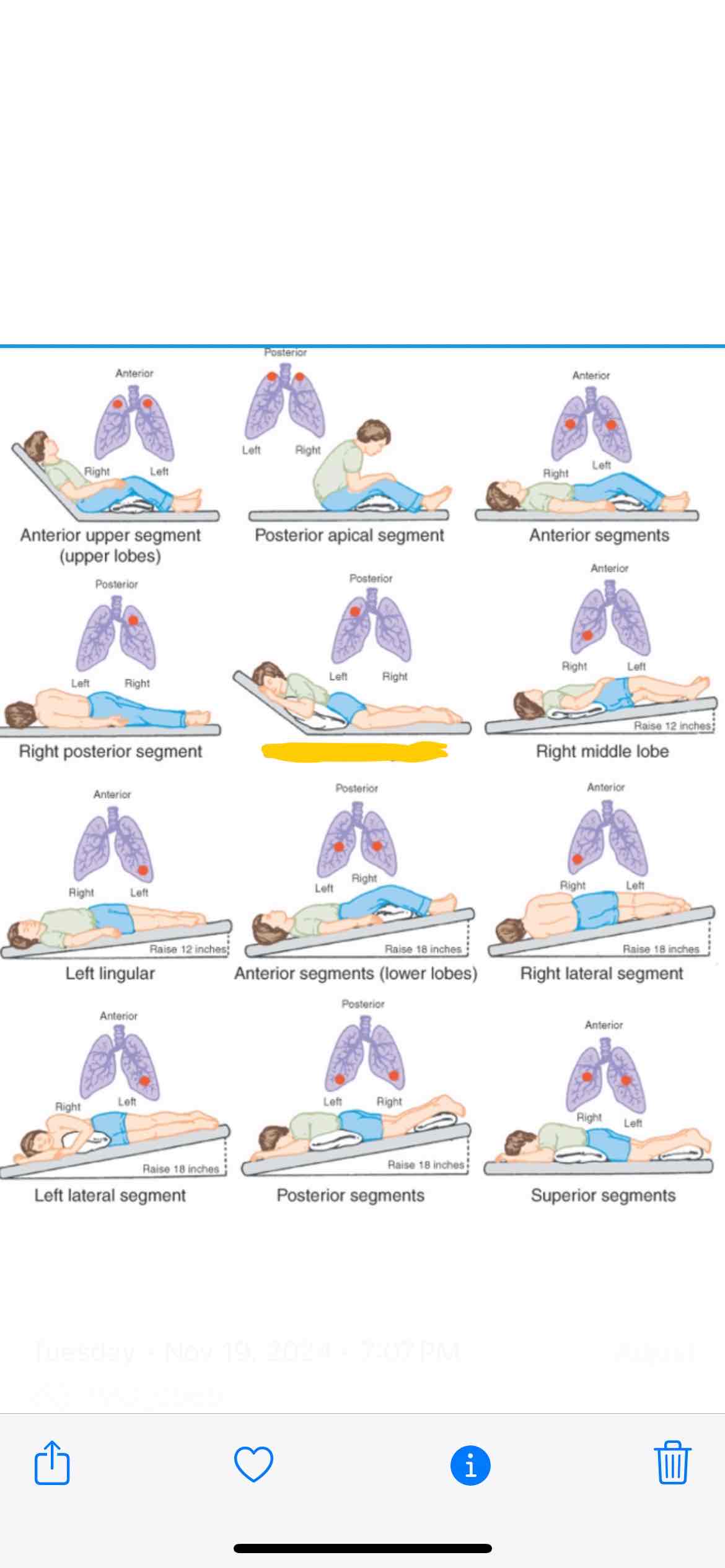 <p><span>Which lung segment does this position effect</span></p>