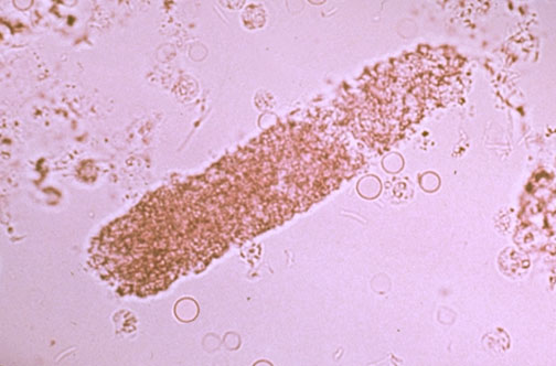 A bacterial cast with RBCs around it