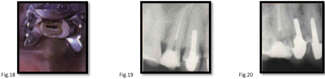<ul><li><p><strong>roots:</strong> usually 1</p><ul><li><p>2 roots in 15%</p></li></ul></li><li><p><strong>canals:</strong></p><ul><li><p>usually 1, broad bucco-palatal</p></li><li><p>2 canals occur in 25%</p></li></ul></li></ul><p><strong>note:</strong> buccopalatal extent may be visible only in oblique radiographs</p>