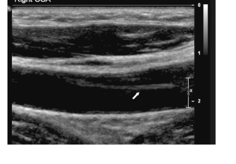 <p>What causes arterial dissection what is it?</p>