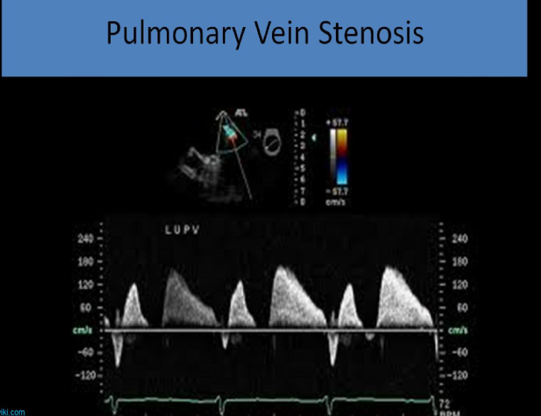 <ul><li><p>peak systolic velocity (s) and peak diastolic velocity (d) both increased</p></li><li><p>flow reveral between systole and diastole</p></li></ul><p></p>