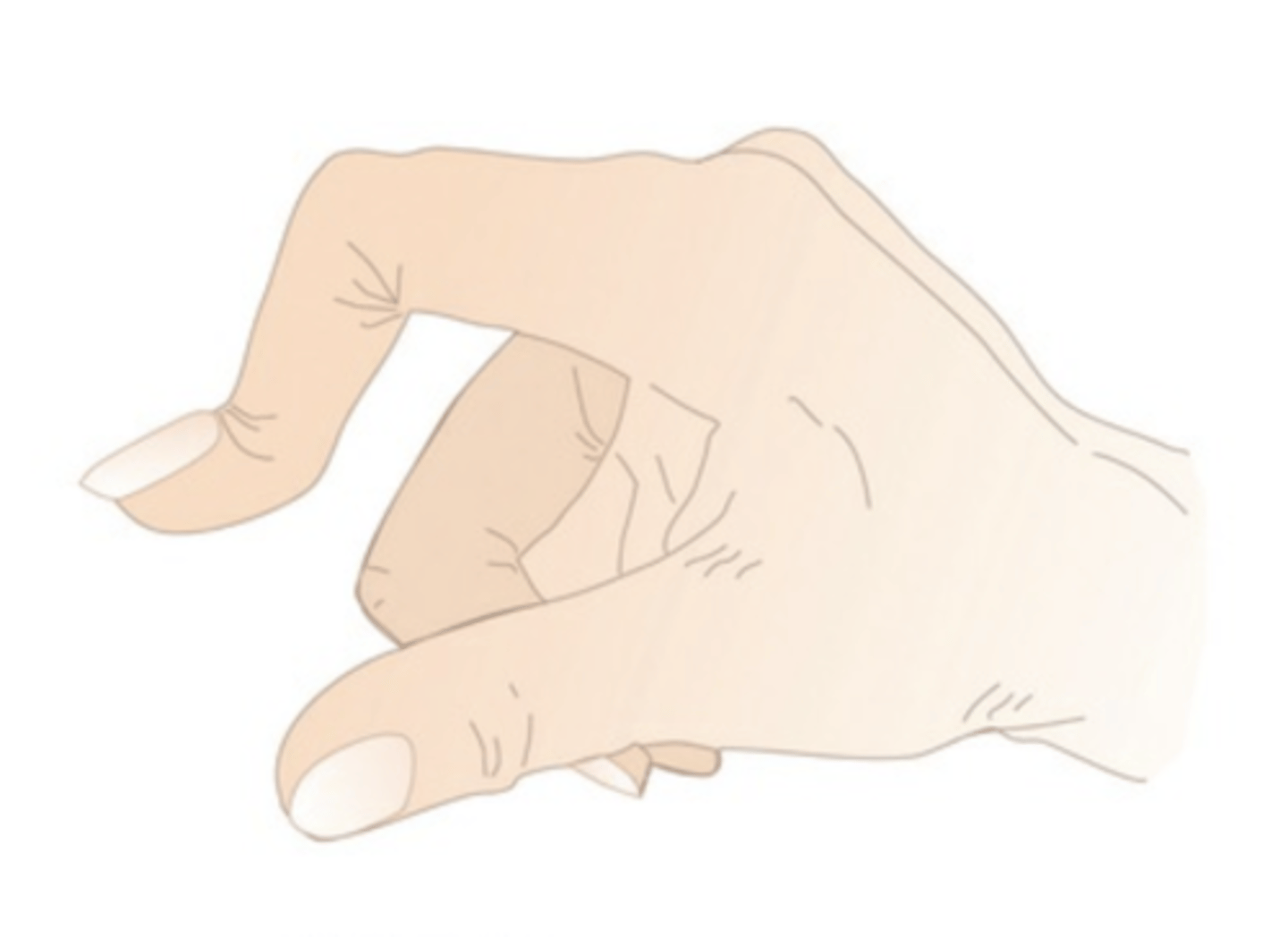 <p>boutonniere deformity</p>