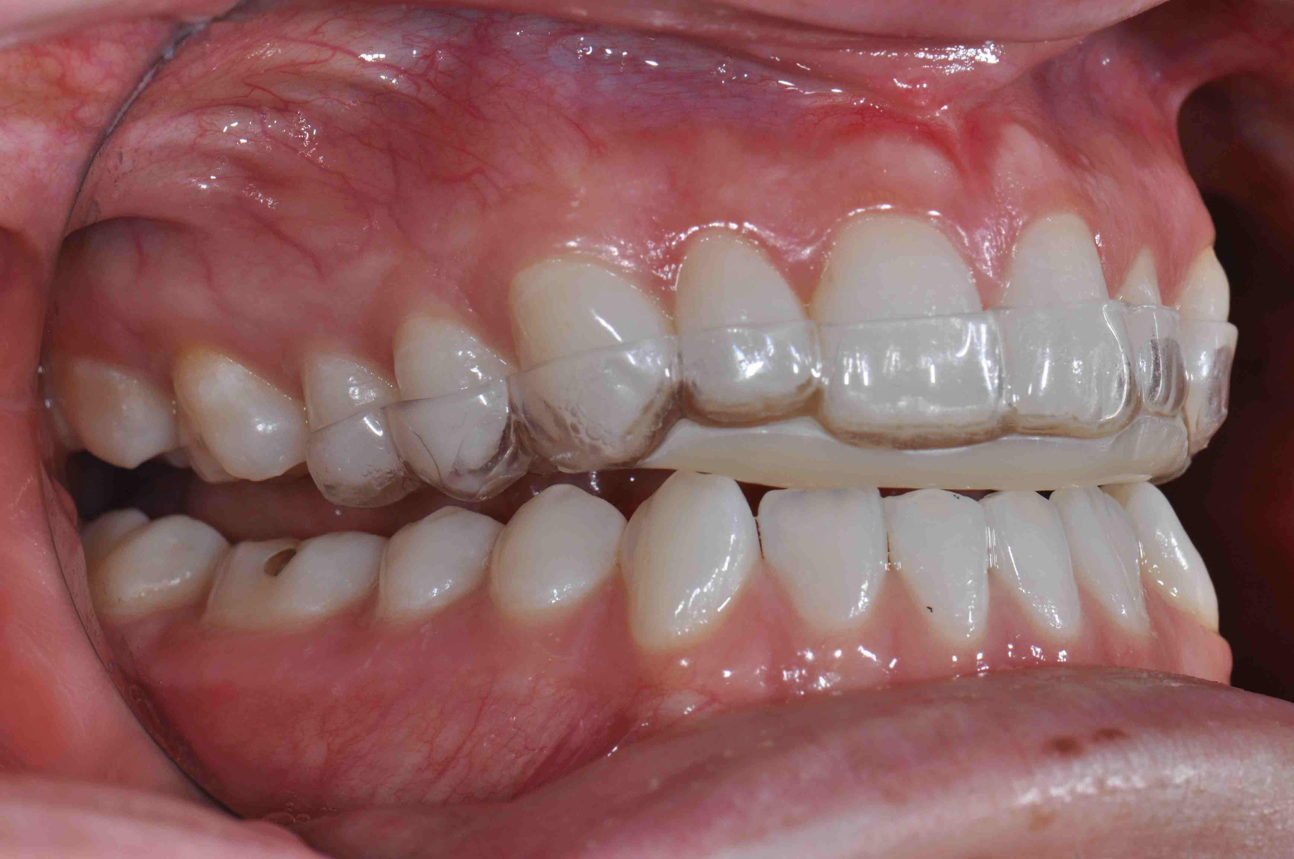 <p>Occlusal device (bite plane)</p>