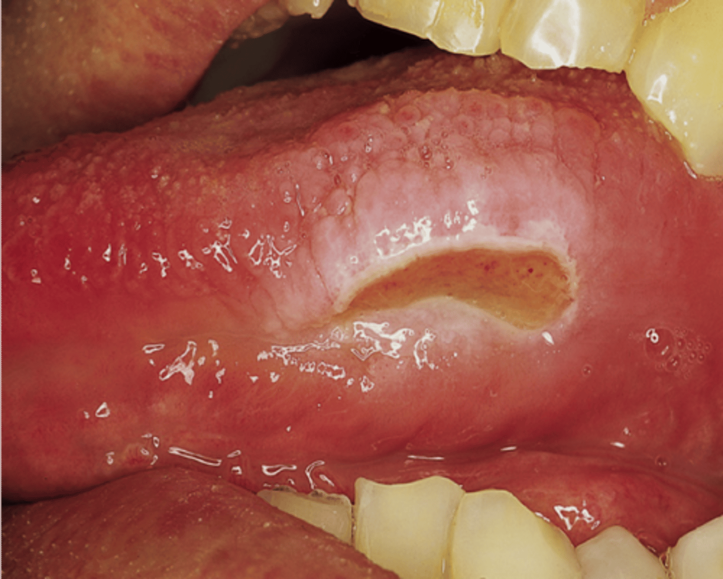 <p>Traumatic Ulcer</p>