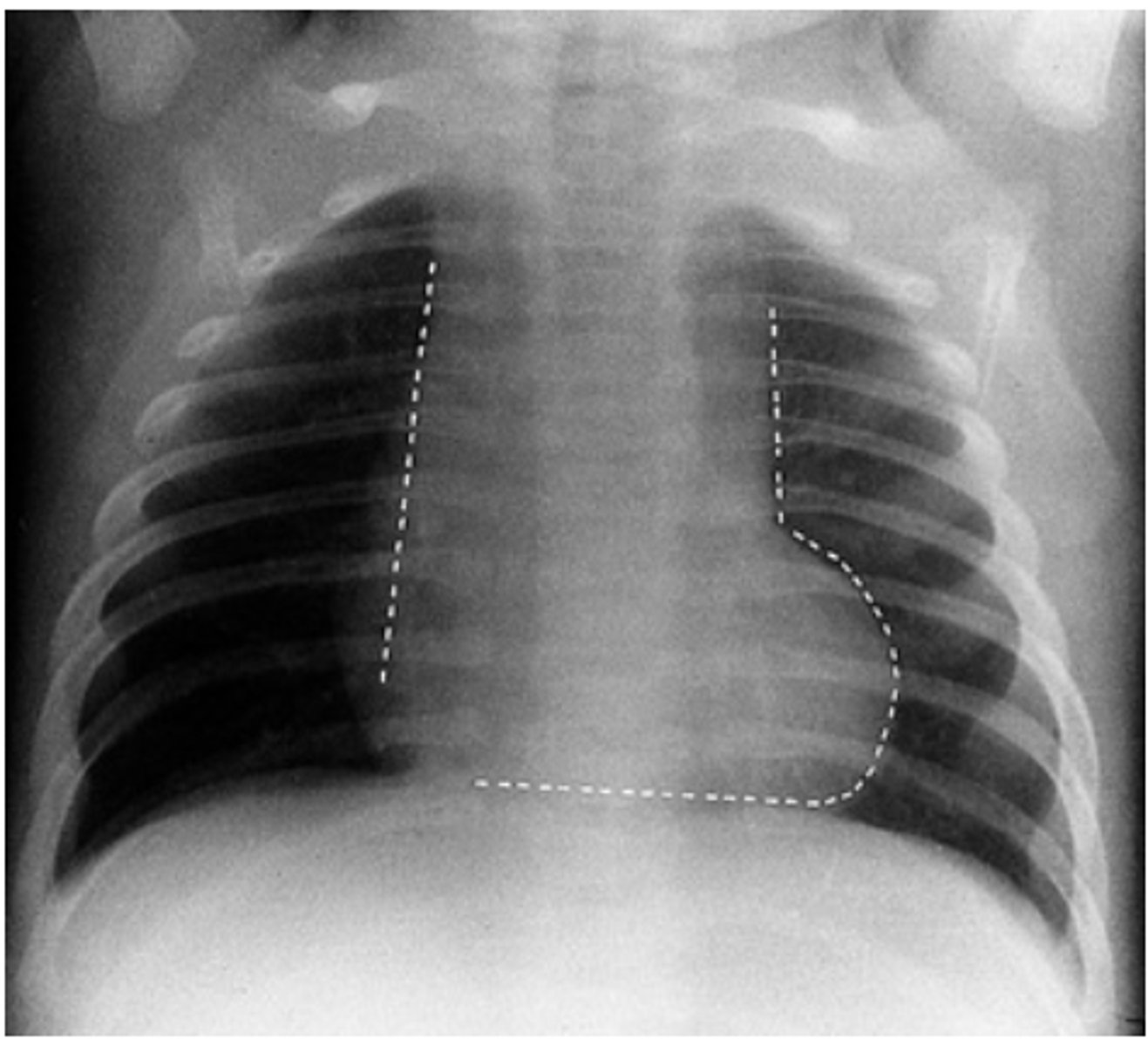 <p>-Pulmonic stenosis</p><p>-VSD</p><p>-Overriding aorta</p><p>-Right ventricular Hypertrophy</p>