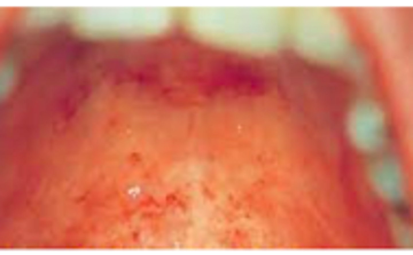 <p>Exanthems:</p><p>Objective:</p><p>- Fever</p><p>- Generalized maculopapular rash</p><p>- Lymphadenopathy</p><p>- Usually posterior cervical, posterior auricular, and suboccipital lymph nodes</p><p>- 5-8 days</p><p>- Mild, nonexudative conjunctivitis</p><p>- Small red spots on soft palate (Forchheimer spots)</p>