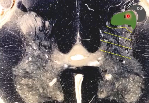 <p>unipolar neurons (C fiber) in dorsal root ganglion→project centrally through lateral portion/division of dorsal root/rootlets→funneled into Lissauer’s tract (dorsolateral fasciculus, DLF)→synapse in lamina 2 (substantia gelatinosa)</p>
