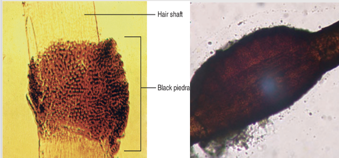 <p><span>Black Piedra-hair with nodules of hyphae around the hair shaft appearing black</span></p>