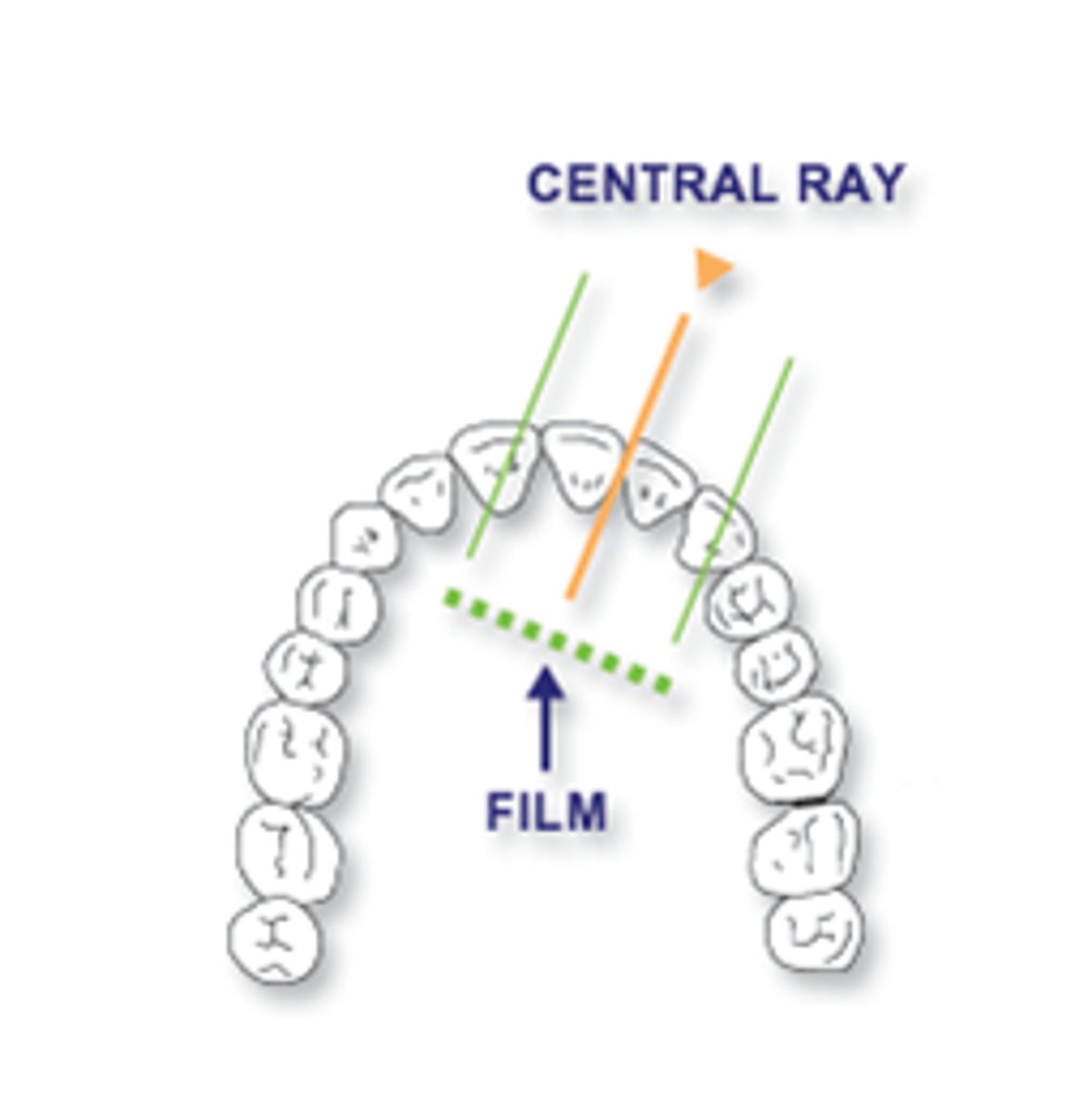 <p>Central ray must pass through the teeth parallel to the proximal surfaces</p>