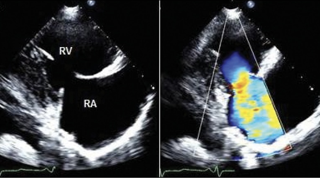 <p><span>is a consequence of the effects of excess hormone production. Serotonin in high concentrations entering the heart from the liver causes fibrosis, particularly in the tricuspid and pulmonic valves, resulting in right-sided heart failure.</span></p><p><span>Nearly 40% of patients exhibiting the carcinoid syndrome will develop ………………….. with fibrotic endocardial plaques and associated heart valve dysfunction that classically involves the tricuspid valve.</span></p><p style="text-align: left"><span>On an echocardiogram this presents a thickening and retraction of the tricuspid valve leaflets during systole. The right-sided image demonstrated severe tricuspid valve regurgitation.</span></p>