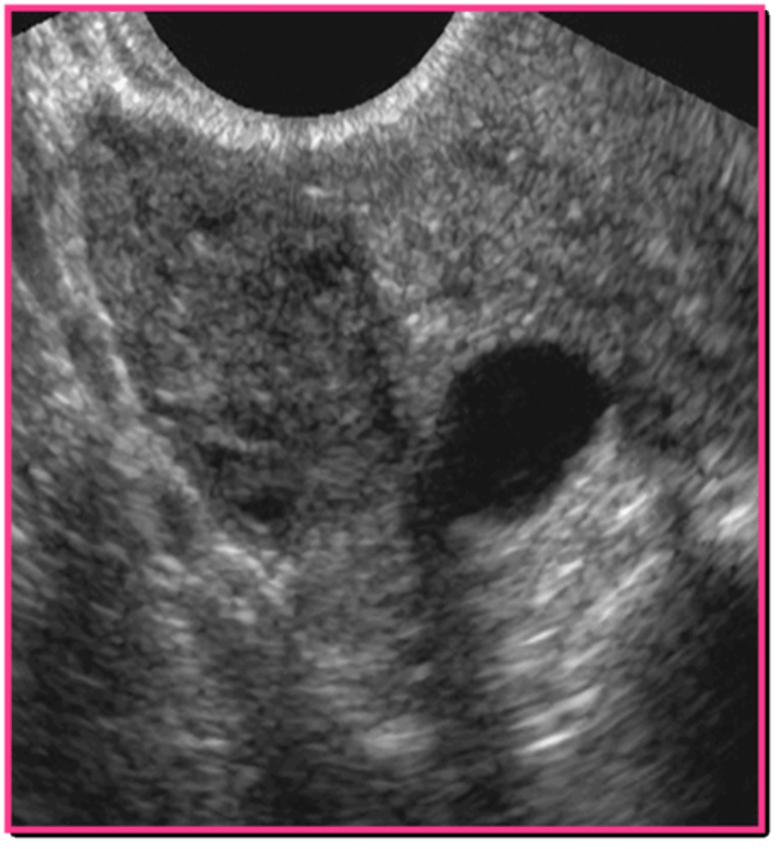<p>fallopian tubes; broad ligament</p>