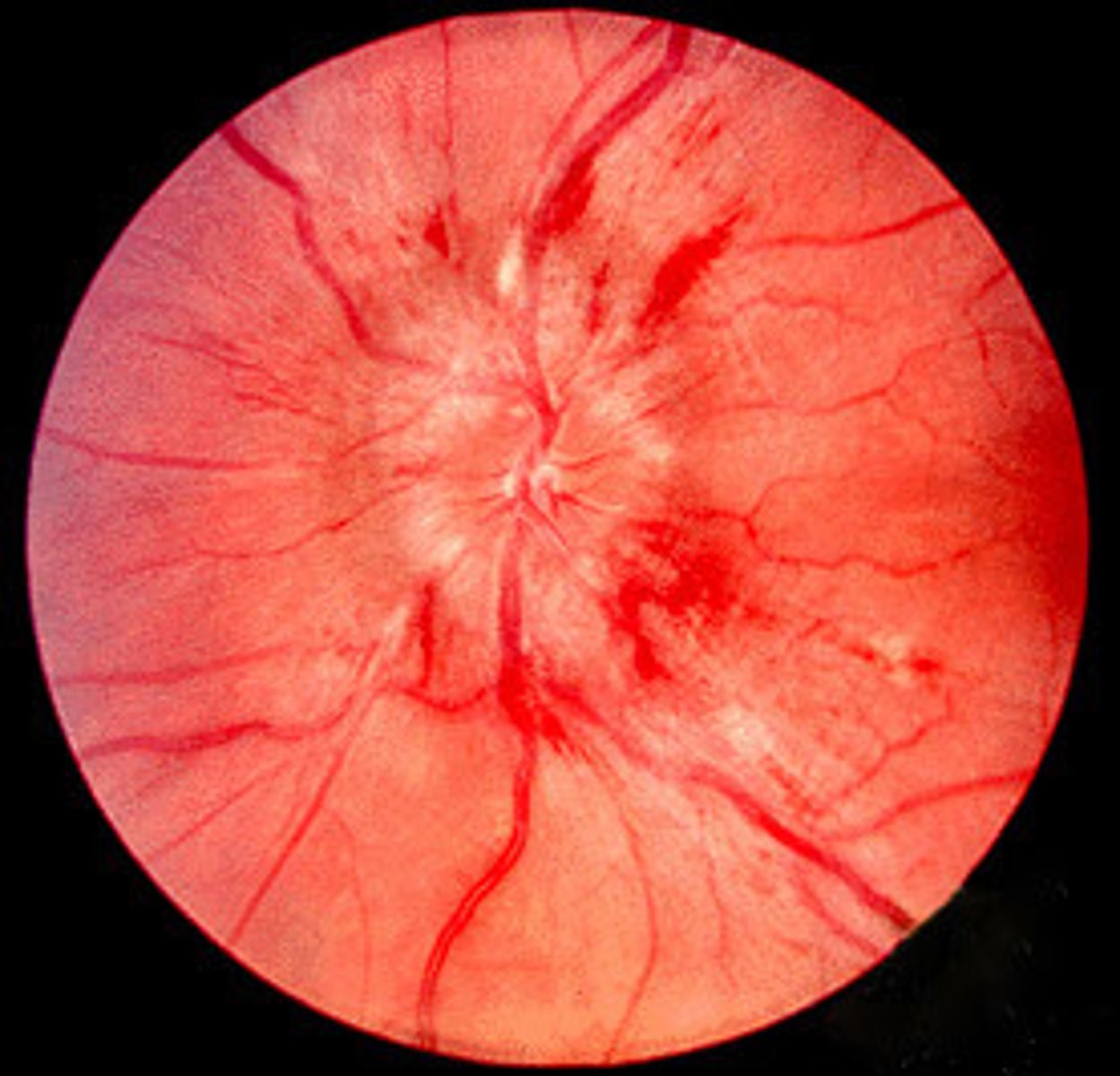 <p>Papilledema; caused by increased intracranial pressure</p>
