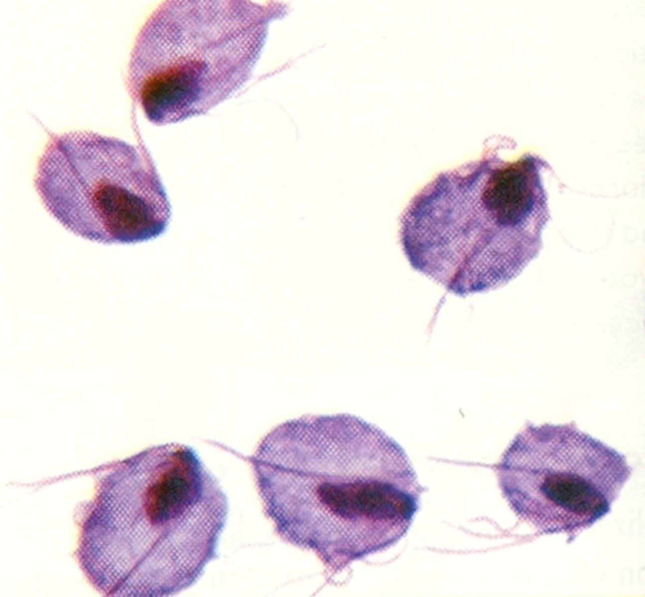 <p>is a very common sexually transmitted disease (STD). It is caused by infection with a protozoan parasite called Trichomonas vaginalis. Although symptoms of the disease vary, most people who have the parasite cannot tell they are infected.</p>