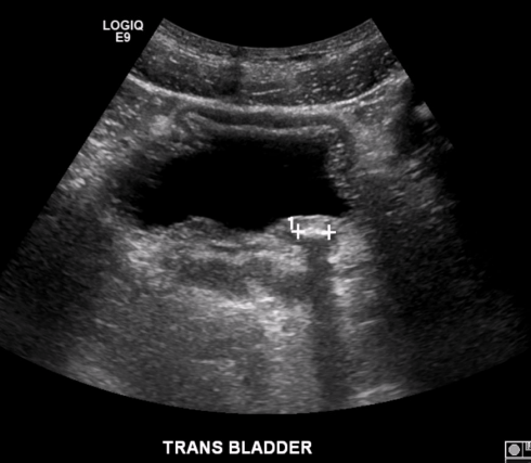 <p>What pathology is present in this image?</p>