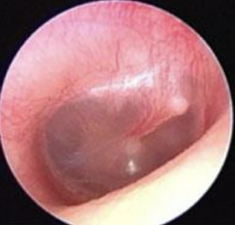 <p>Comment on this tympanic membrane</p>