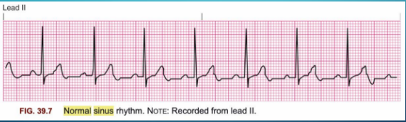 What a normal ECG should look like.**