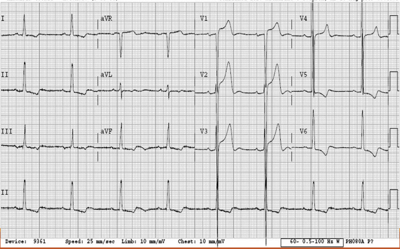 <p>What kind of heart problem is this + how to spot it?</p>